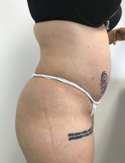 Brazilian Butt Lift Before & After Patient #6001