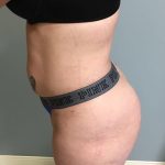 Brazilian Butt Lift Before & After Patient #6001