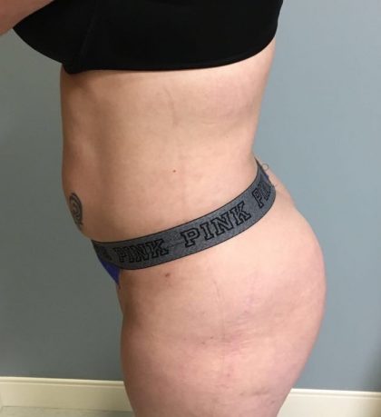 Brazilian Butt Lift Before & After Patient #6001