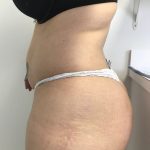 Brazilian Butt Lift Before & After Patient #6001