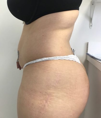 Brazilian Butt Lift Before & After Patient #6001