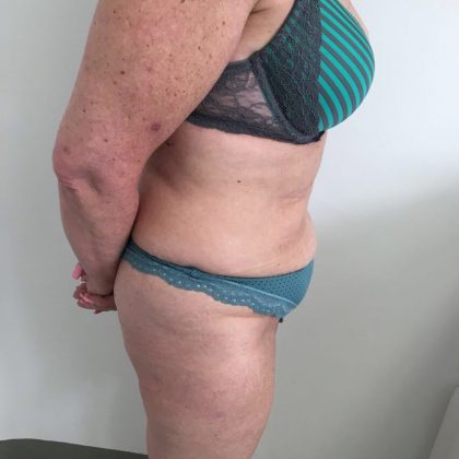 Tummy Tuck Before & After Patient #6044