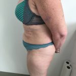Tummy Tuck Before & After Patient #6044