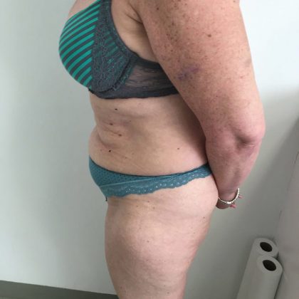 Tummy Tuck Before & After Patient #6044