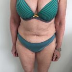 Tummy Tuck Before & After Patient #6044