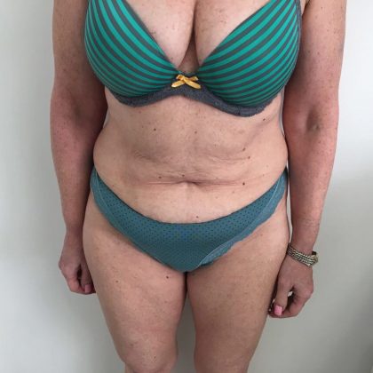 Tummy Tuck Before & After Patient #6044