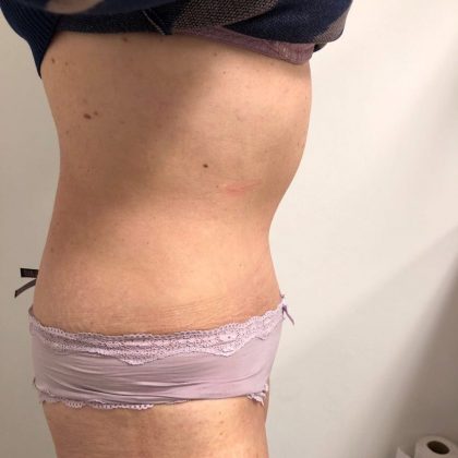 Tummy Tuck Before & After Patient #6044