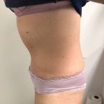 Tummy Tuck Before & After Patient #6044