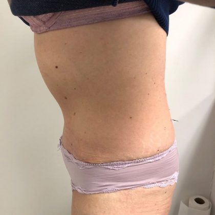 Tummy Tuck Before & After Patient #6044