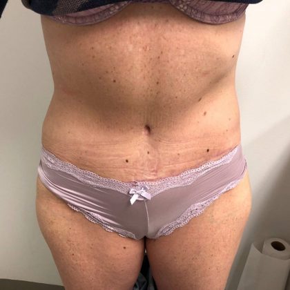 Tummy Tuck Before & After Patient #6044
