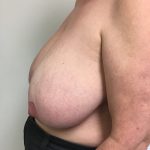 Breast Reduction Before & After Patient #6033