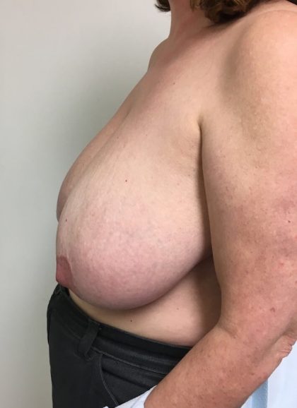 Breast Reduction Before & After Patient #6033