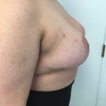 Breast Reduction Before & After Patient #6024