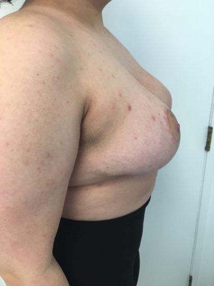 Breast Reduction Before & After Patient #6024