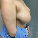 Breast Reduction Before & After Patient #6024
