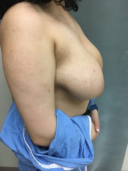 Breast Reduction Before & After Patient #6024