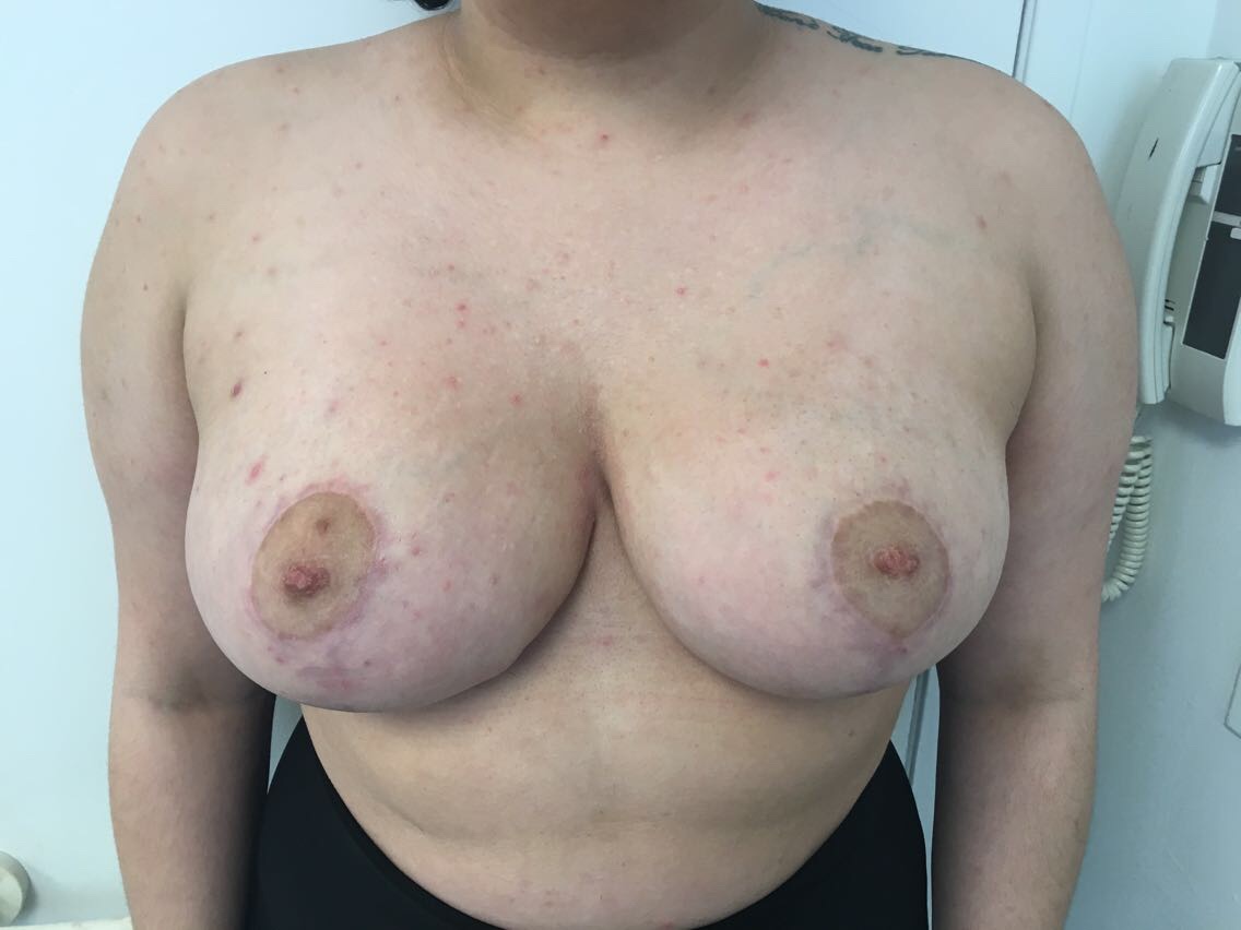 Breast Reduction Before & After Patient #6024