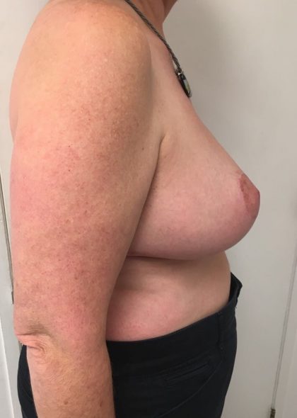 Breast Reduction Before & After Patient #6033