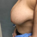 Breast Reduction Before & After Patient #6024