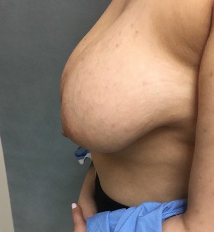 Breast Reduction Before & After Patient #6024