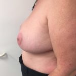 Breast Reduction Before & After Patient #6033