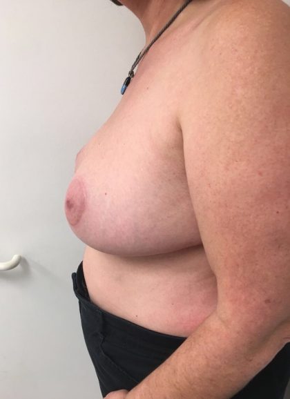Breast Reduction Before & After Patient #6033