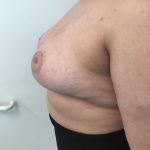 Breast Reduction Before & After Patient #6024