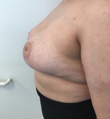 Breast Reduction Before & After Patient #6024
