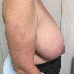 Breast Reduction Before & After Patient #6033