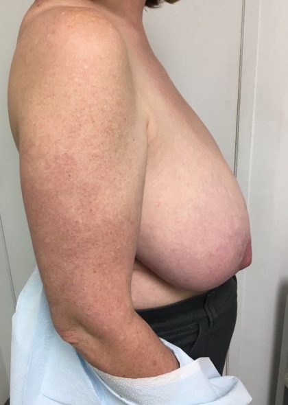 Breast Reduction Before & After Patient #6033