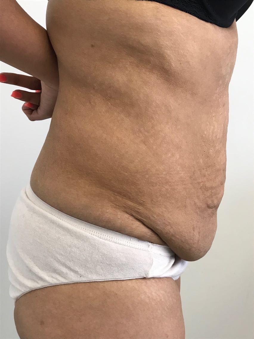 Tummy Tuck Before & After Patient #6051