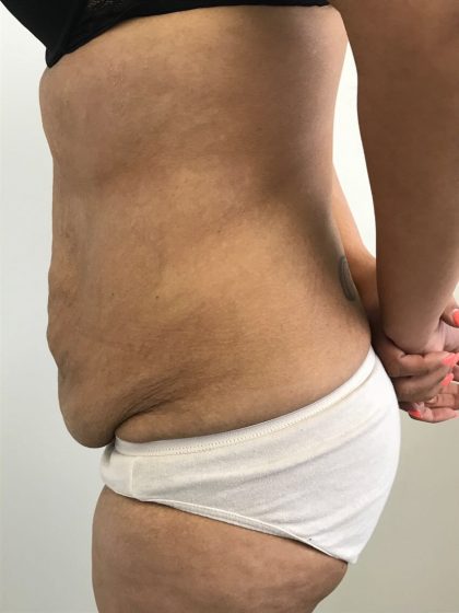 Tummy Tuck Before & After Patient #6051