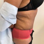 Tummy Tuck Before & After Patient #6051
