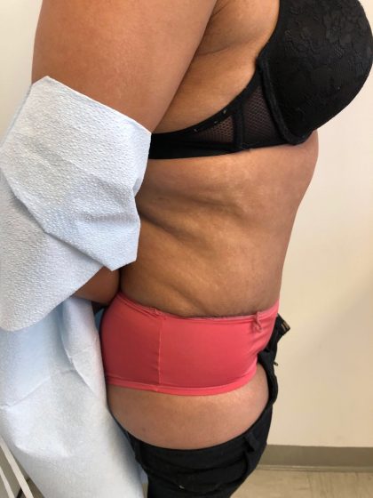 Tummy Tuck Before & After Patient #6051