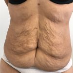 Tummy Tuck Before & After Patient #6051