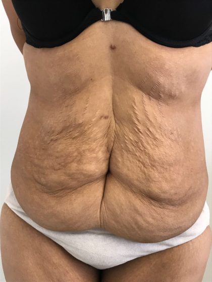 Tummy Tuck Before & After Patient #6051