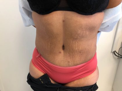 Tummy Tuck Before & After Patient #6051