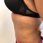 Tummy Tuck Before & After Patient #6051