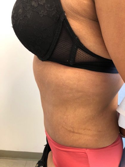 Tummy Tuck Before & After Patient #6051