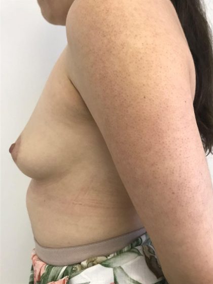 Breast Augmentation Before & After Patient #6124
