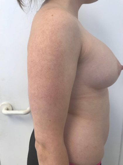Breast Augmentation Before & After Patient #6124