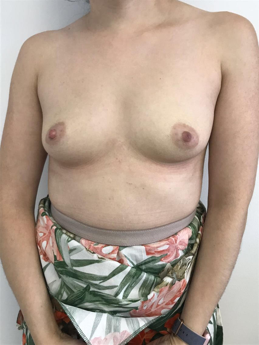 Breast Augmentation Before & After Patient #6124