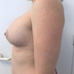 Breast Augmentation Before & After Patient #6124