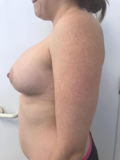 Breast Augmentation Before & After Patient #6124