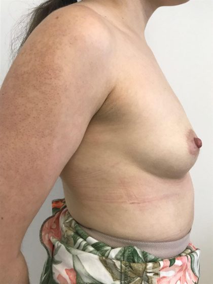 Breast Augmentation Before & After Patient #6124