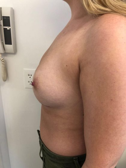 Breast Augmentation Before & After Patient #6132