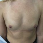 Breast Augmentation Before & After Patient #6132
