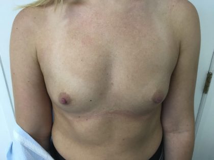 Breast Augmentation Before & After Patient #6132