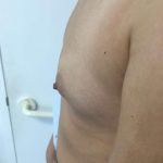 Breast Augmentation Before & After Patient #6132