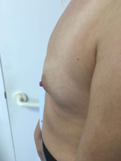 Breast Augmentation Before & After Patient #6132